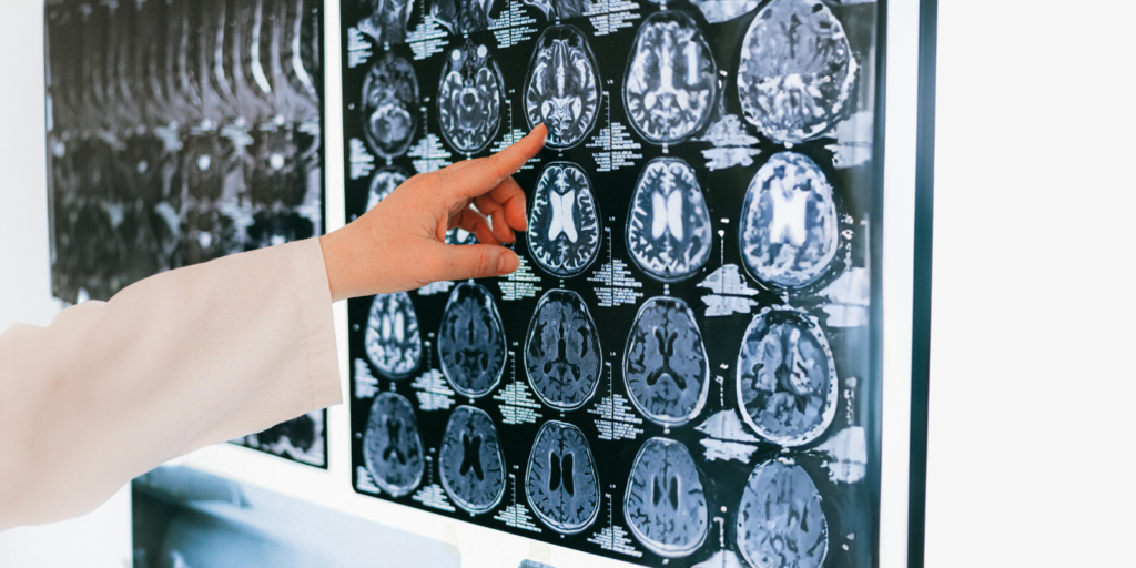 hand pointing to brain scan