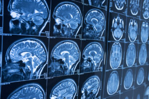Can I Still Recover Compensation If I Am Being Blamed for a Brain Injury in California?